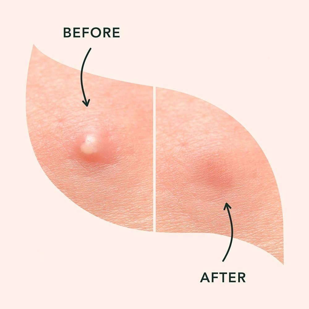No Show Invisible Acne Patch – Hydrocolloid Pimple Patches for Fast Healing & Blemish Control