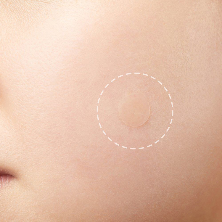 No Show Invisible Acne Patch – Hydrocolloid Pimple Patches for Fast Healing & Blemish Control