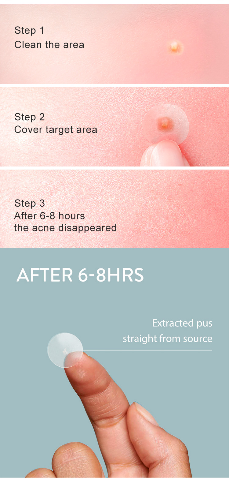 No Show Invisible Acne Patch – Hydrocolloid Pimple Patches for Fast Healing & Blemish Control