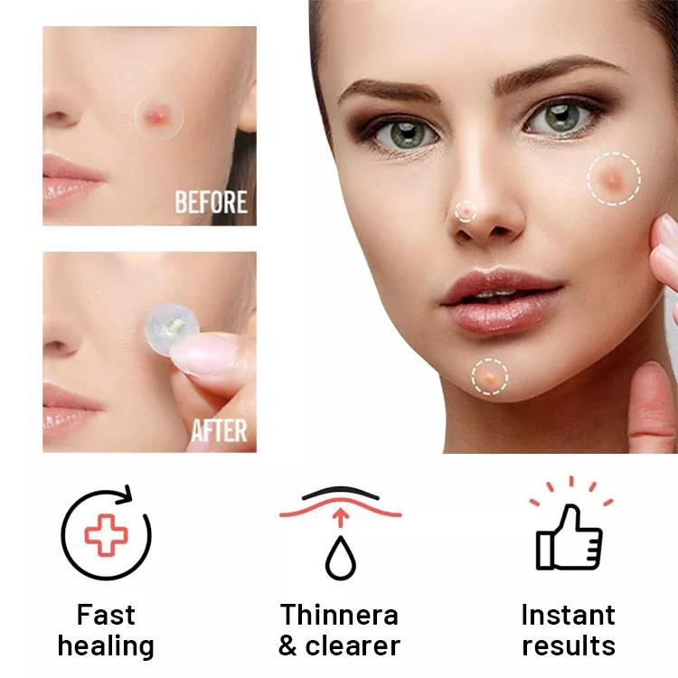 No Show Invisible Acne Patch – Hydrocolloid Pimple Patches for Fast Healing & Blemish Control