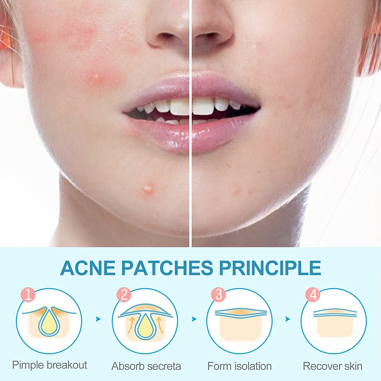 No Show Invisible Acne Patch – Hydrocolloid Pimple Patches for Fast Healing & Blemish Control
