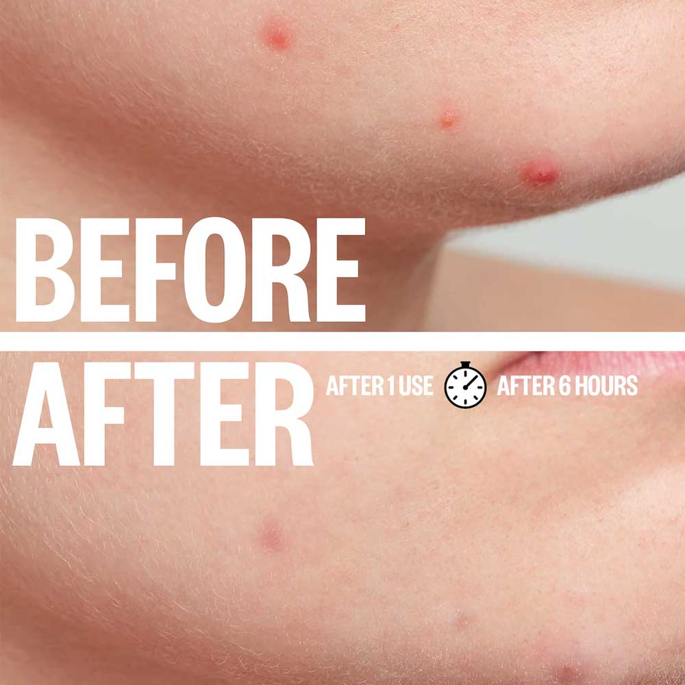 No Show Invisible Acne Patch – Hydrocolloid Pimple Patches for Fast Healing & Blemish Control